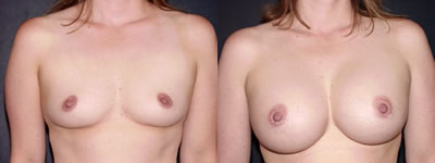 Breast augmentation