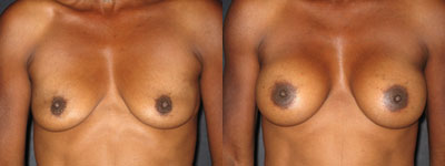 Breast augmentation