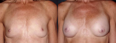 Breast augmentation