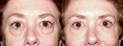 Eyelid