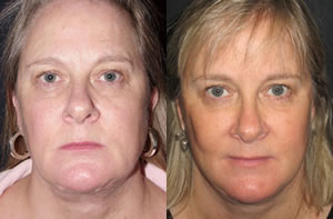 Face lift