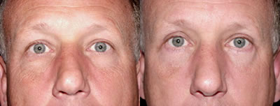 Rhinoplasty