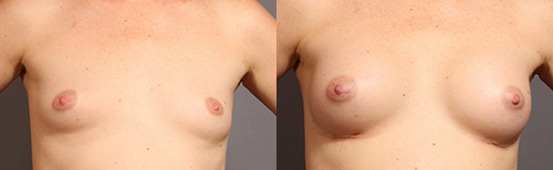 Breast augmentation