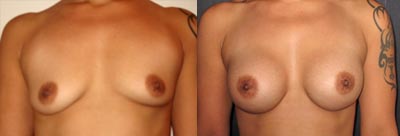 Breast augmentation