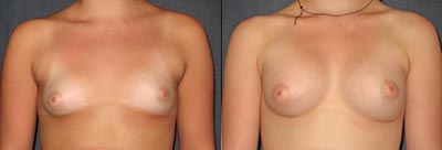 Breast augmentation
