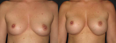 Breast augmentation