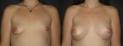 Breast augmentation