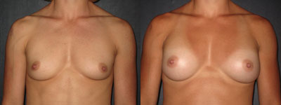 Breast augmentation