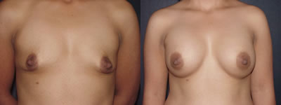 Breast augmentation