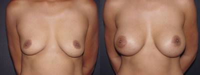 Breast augmentation