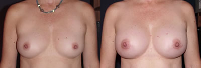 Breast augmentation