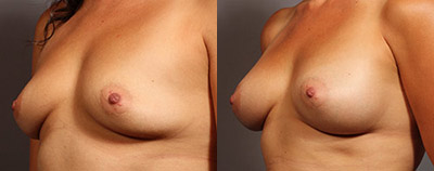 Breast augmentation