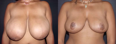 Breast reduction