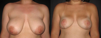 Breast reduction