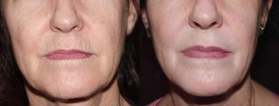 Chemical peel