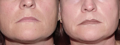 Chemical peel