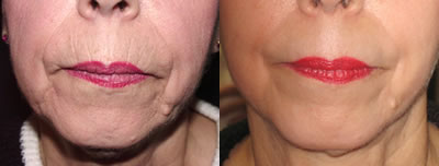 Chemical peel