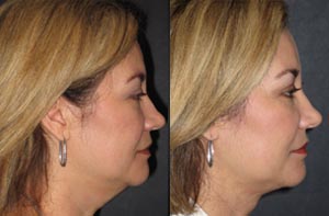 Chin liposuction