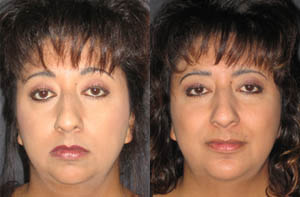 Chin augmentation