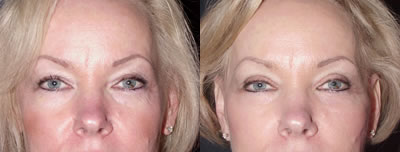 Eyelid