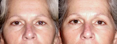 Eyelid