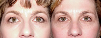 Eyelid