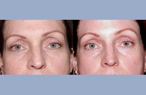 Eyelid