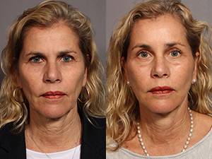 Facelift Thumb