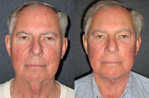Facelift Thumb