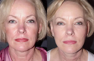 Face lift