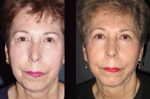 Face lift