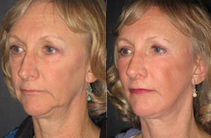 Facelift thumb