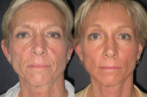 Facelift thumbnail