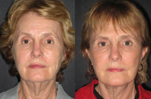 Facelift thumbnail