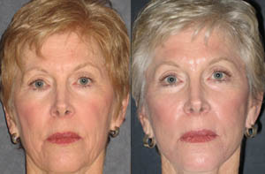 Facelift thumbnail
