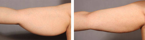 Liposuction