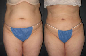 Liposuction