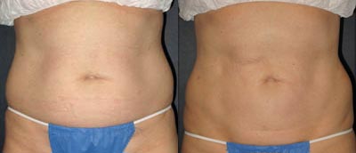 Liposuction
