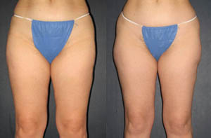 Liposuction