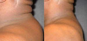 Liposuction
