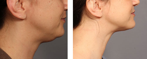 Liposuction