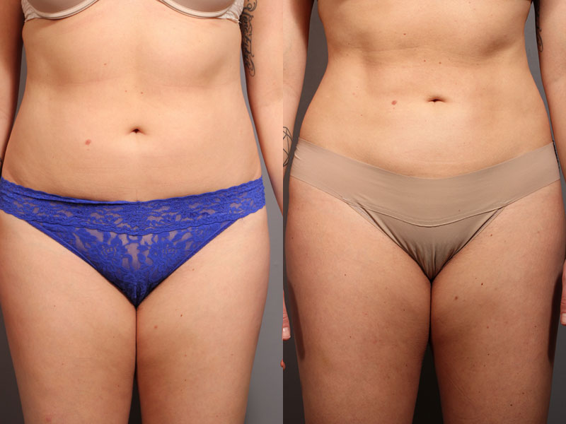 Liposuction