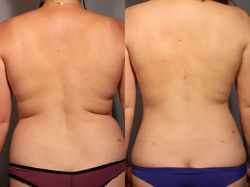 Liposuction