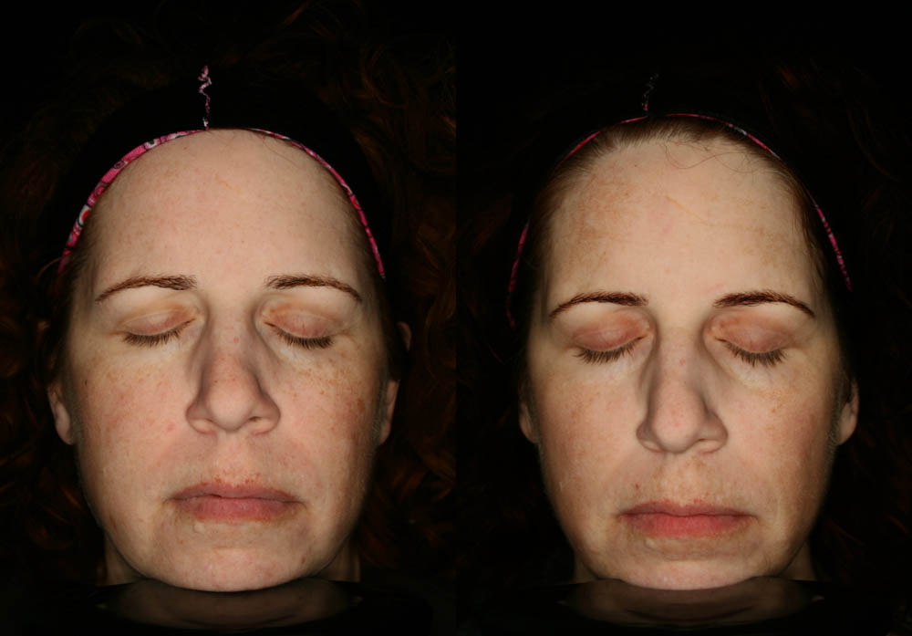 MixTo CO2 Laser