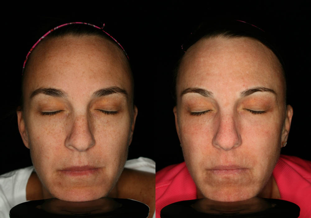 MixTo CO2 Laser