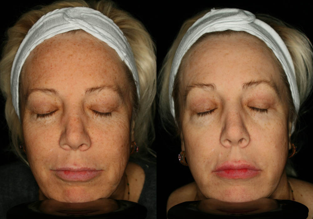 MixTo CO2 Laser