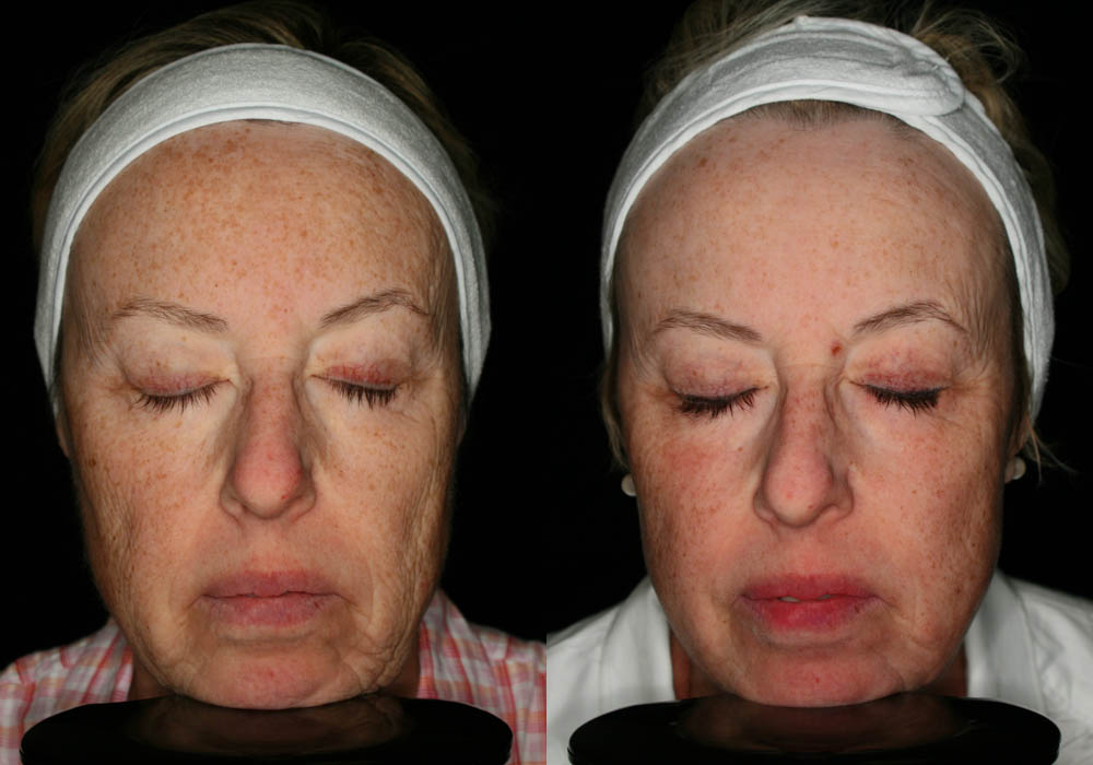 MixTo CO2 Laser