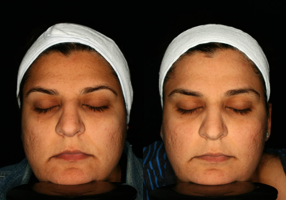 MixTo CO2 Laser