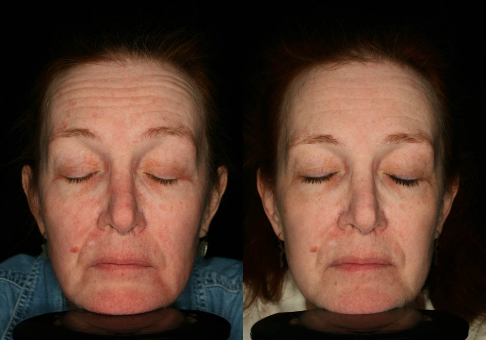 MixTo CO2 Laser