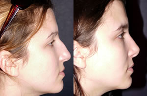 Rhinoplasty